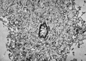 M,42y. | malignant mesothelioma - pleura M,42y. | malignant mesothelioma - pleura
